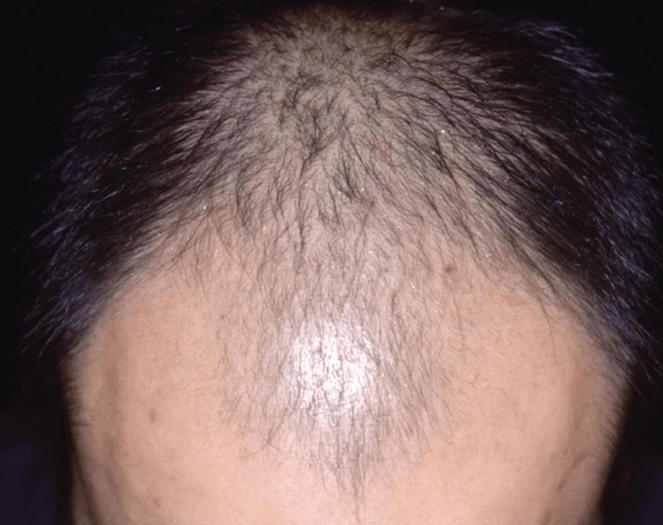 Erkekte görülen erkek tipi saç dökülmesi