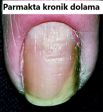 Kronik paronisi