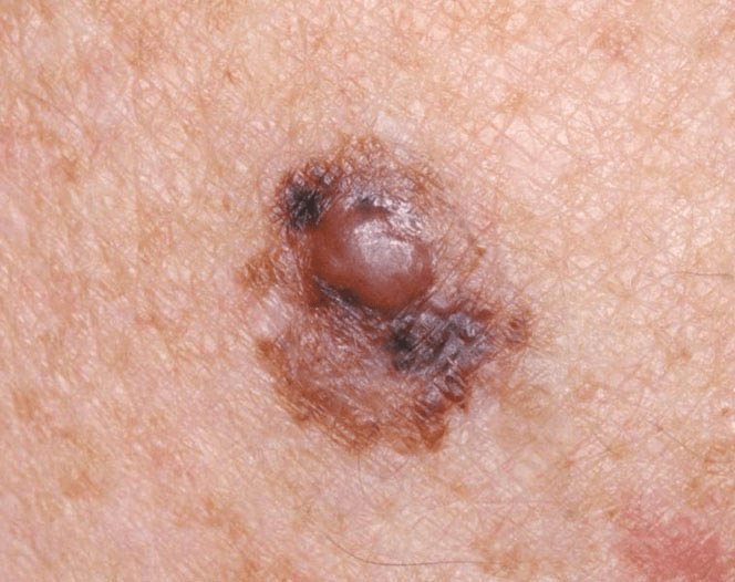 Kanserli ben malign melanom
