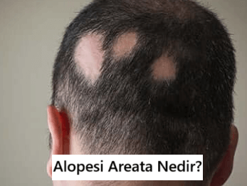 Alopesi Areata (Saçkıran) Nedir?