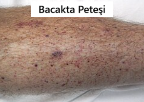 Peteşi Nedir?