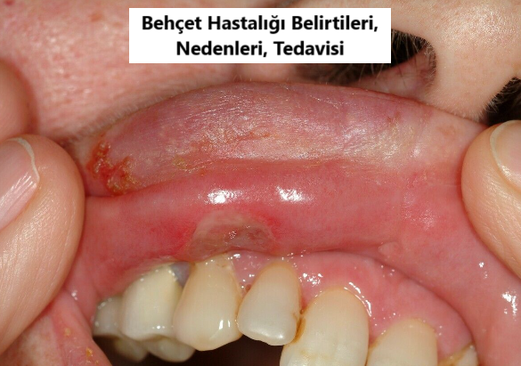 Behçet Hastalığı Nedir? Behçet Hastalığı Belirtileri Nelerdir?