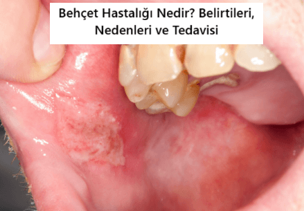 Behçet Hastalığı: Belirtiler ve Tanı
