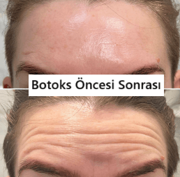 Botoks: Kullanımı ve Yan Etkileri