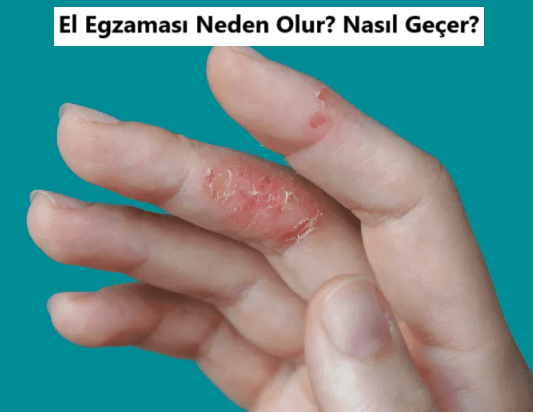 El Egzaması Nedir? El Egzaması Neden Olur?