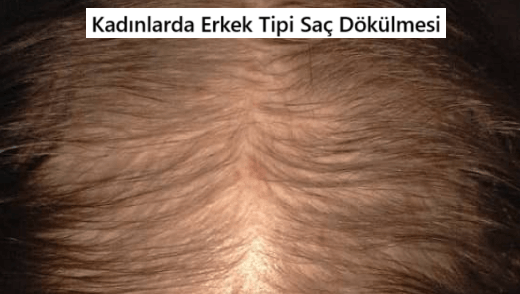 Erkek Tipi Saç Dökülmesi: Belirtiler ve Tedavi