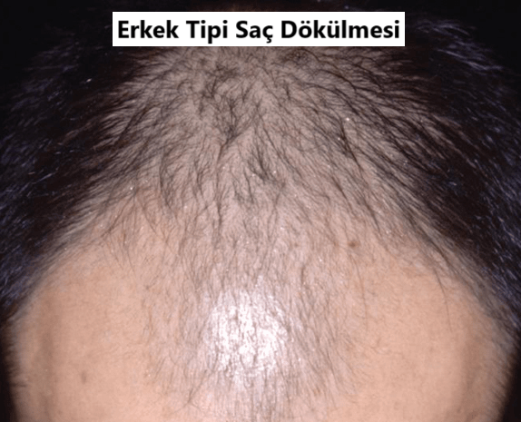 erkek tipi saç dökülmesi nedir