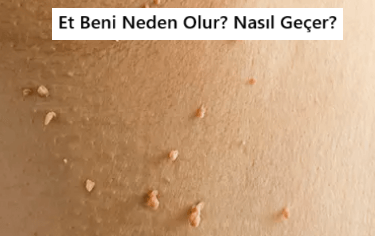 Et Beni Nedir? Et Beni Neden Çıkar?