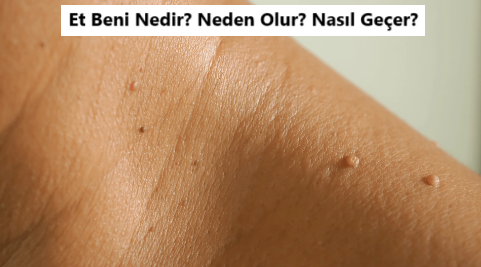 Et Beni Nedir? Et Beni Neden Çıkar?