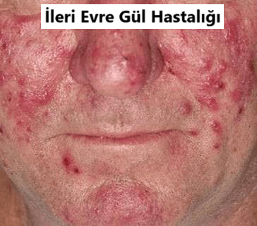 gul hastaligi resimleri