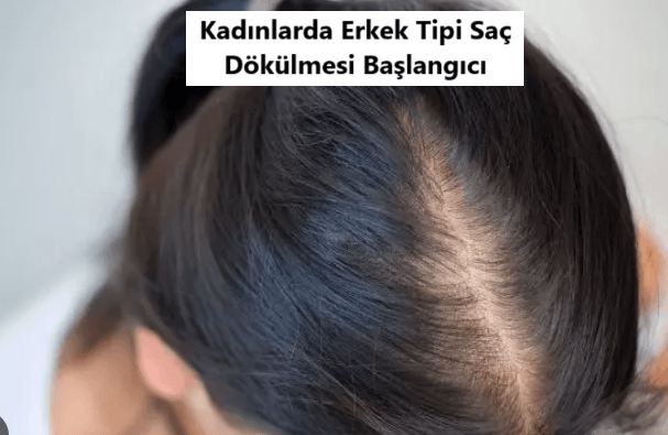 Erkek Tipi Saç Dökülmesi Nedir? Tedavisi Nedir?