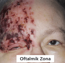 oftalmik zona