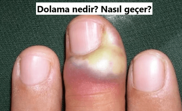 Dolama (Paronişi) Nedir? Dolama Nasıl Geçer?