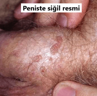 peniste siğil resmi