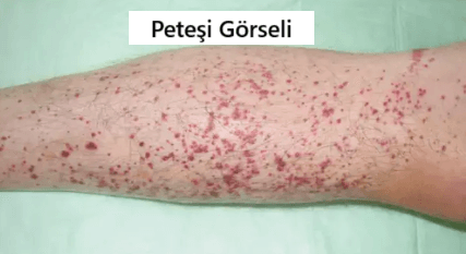 peteşi nedir