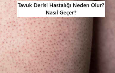 Tavuk Derisi Hastalığı Nedir?