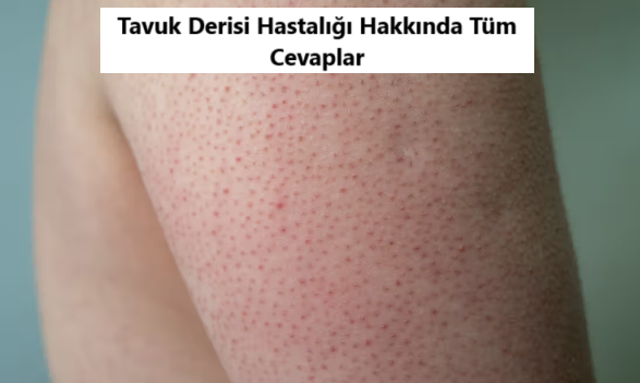 Tavuk Derisi Hastalığı Nedir?