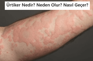 Ürtiker Nedir? Kronik İdiyopatik Ürtiker Belirtileri