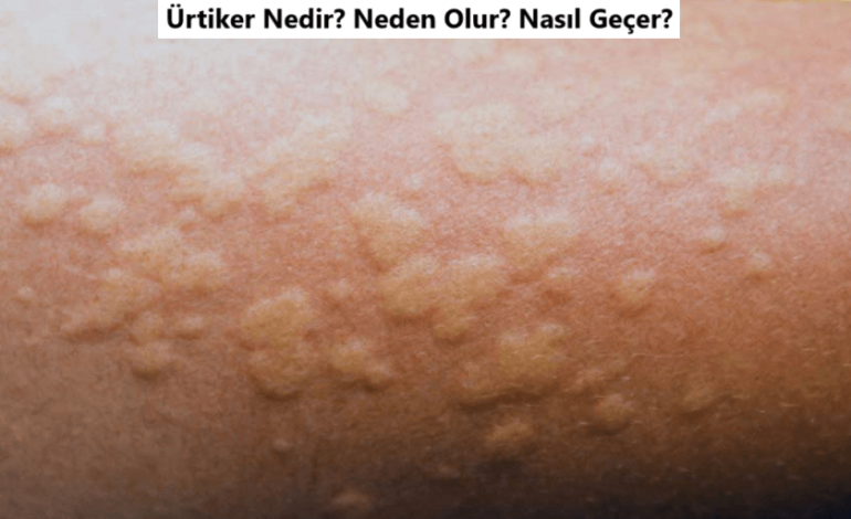 ürtiker nedir