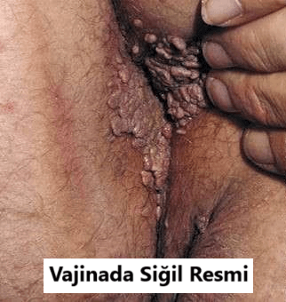 vajinada siğil fotoğrafları