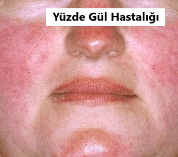 yüzde gül hastalığı