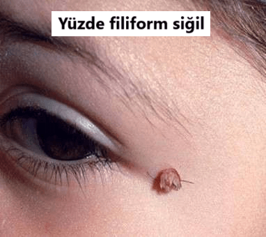 yüzde siğil