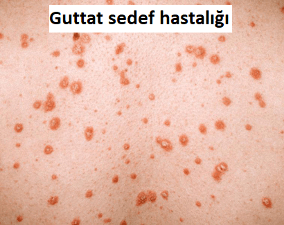 Guttat psoriazis