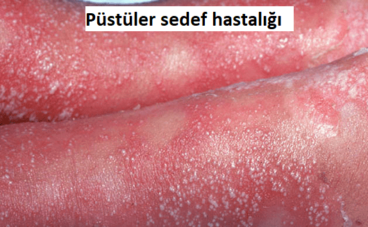 Pustuler sedef hastaligi