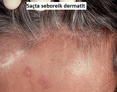 Sacta seboreik dermatit resmi