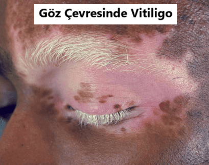 Vitiligo goz cevresi