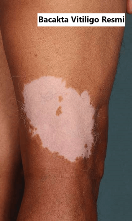 Vitiligo resmi