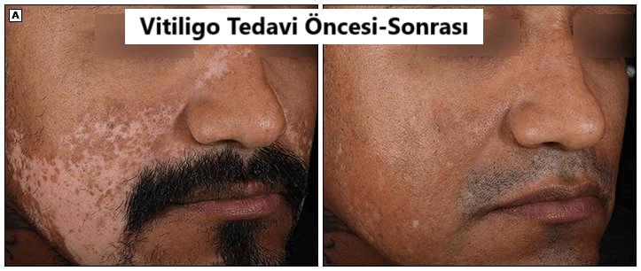 Vitiligo tedavi öncesi sonrası