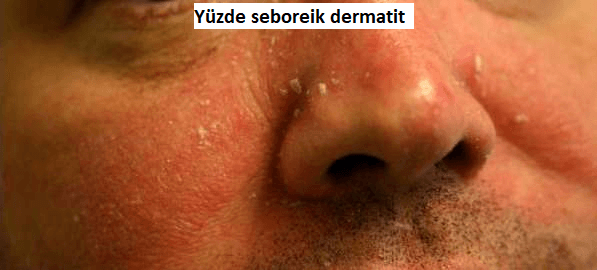 Yuzde seboreik dermatit