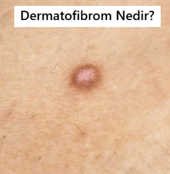 dermatofibrom nedir