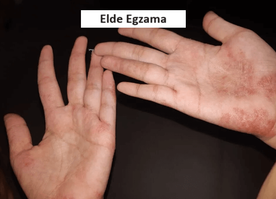 elde egzama resmi