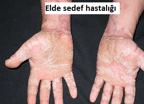 elde sedef hastalığı