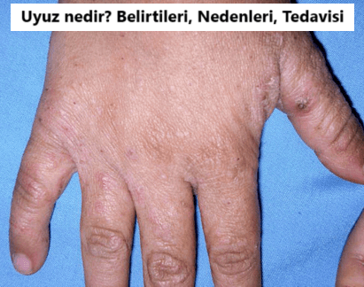 Uyuz Nedir? Uyuz Nasıl Geçer?