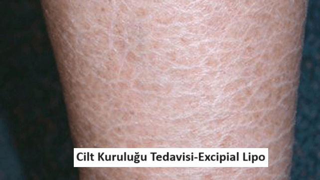 excipial lipo krem