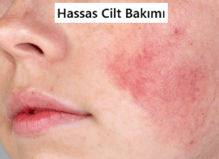 Hassas Cilt Nedir?
