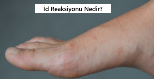 İd Reaksiyonu Nedir?