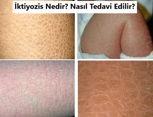 İktiyozis Nedir?