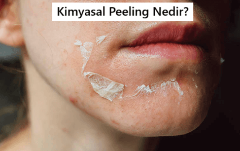 Kimyasal Peeling Nedir?