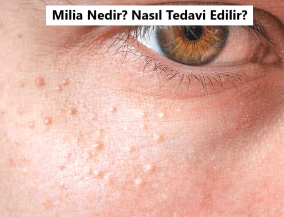 Milia Nedir? Milia Nasıl Geçer?