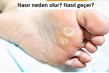 Nasır Neden Olur? Nasır Nasıl Geçer?