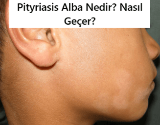 pityriasis alba nedir