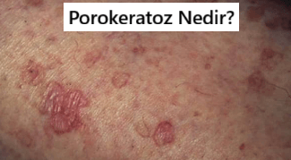 Porokeratoz Nedir?