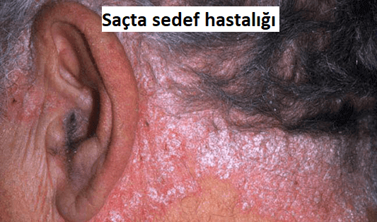 sacta sedef hastalığı