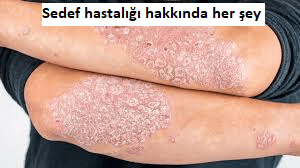 Sedef Hastalığı Nedir? Belirtileri, Nedenleri, Tedavisi