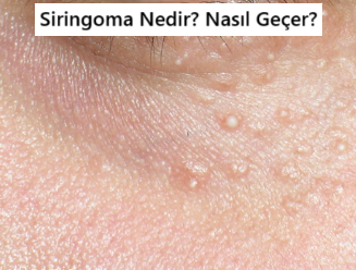 Siringoma Nedir?