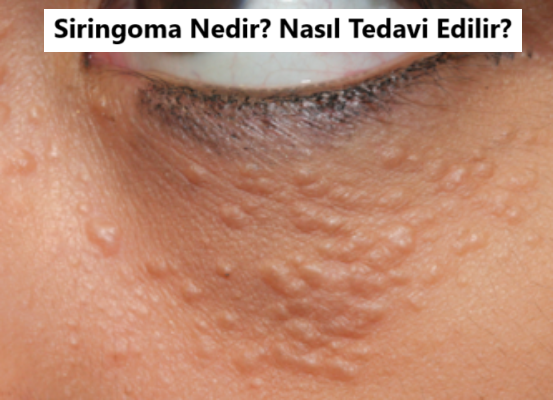 siringoma nedir